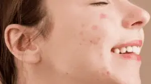 acne facial